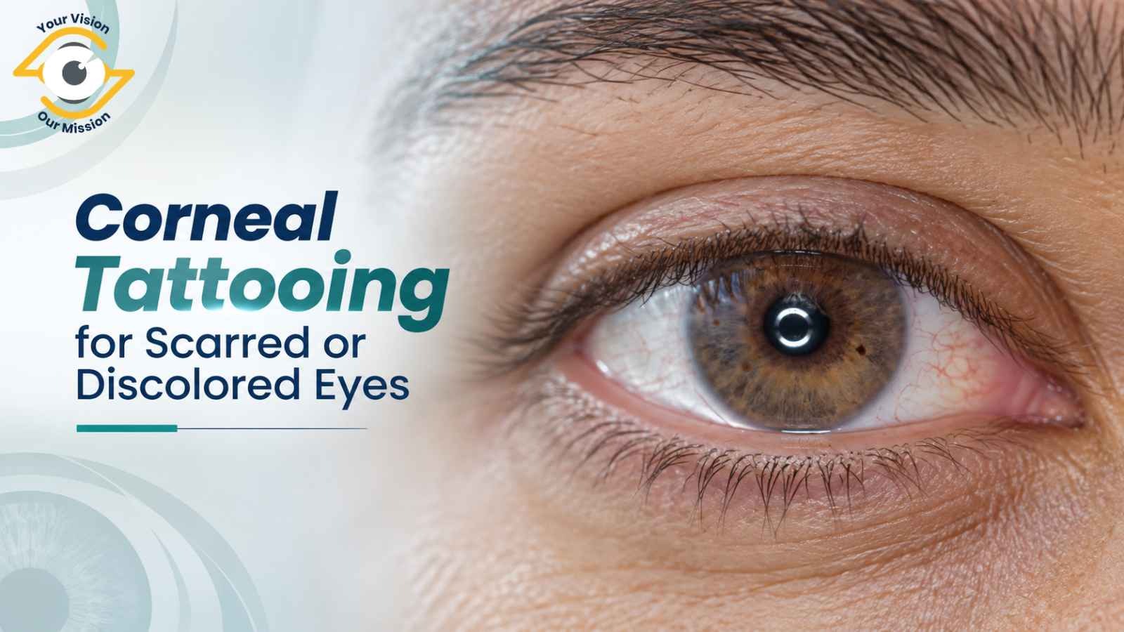 Living With a Scarred or Discolored Eye? How a Corneal Tattooing Specialist Can Help